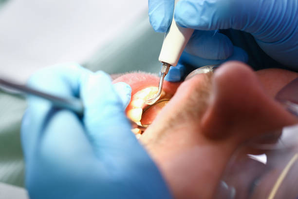 Best Emergency Wisdom Teeth Removal in Odem, TX